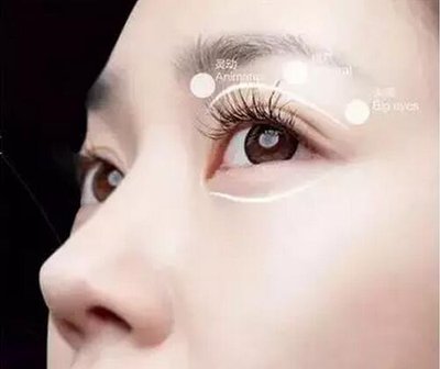全切双眼皮三个月了能修复吗?3个月能够修复好吗?